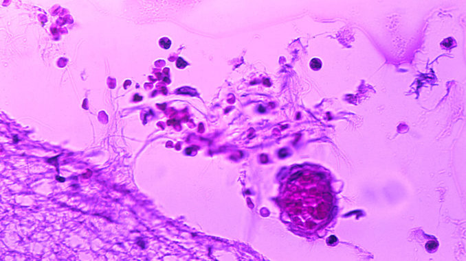 meningitis1