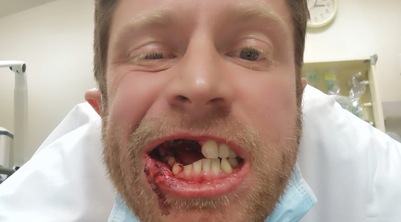 Bedale man loses three teeth after vape explodes as he's taking a puff